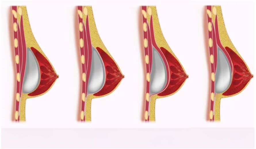 Availability for implant installation