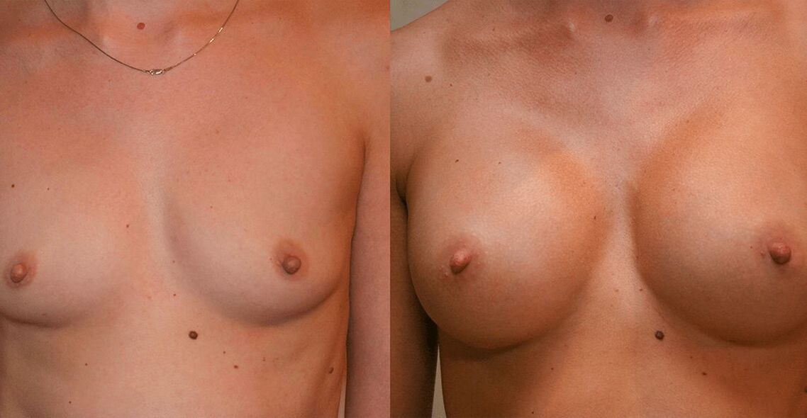 Before and after breast augmentation