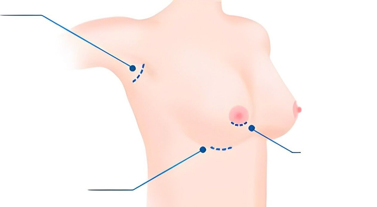 Size types for breast augmentation